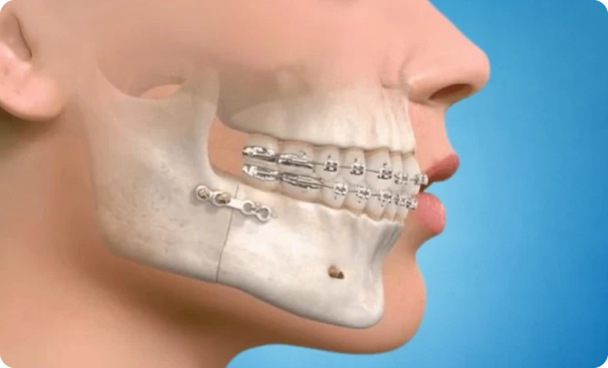 Dental Implants